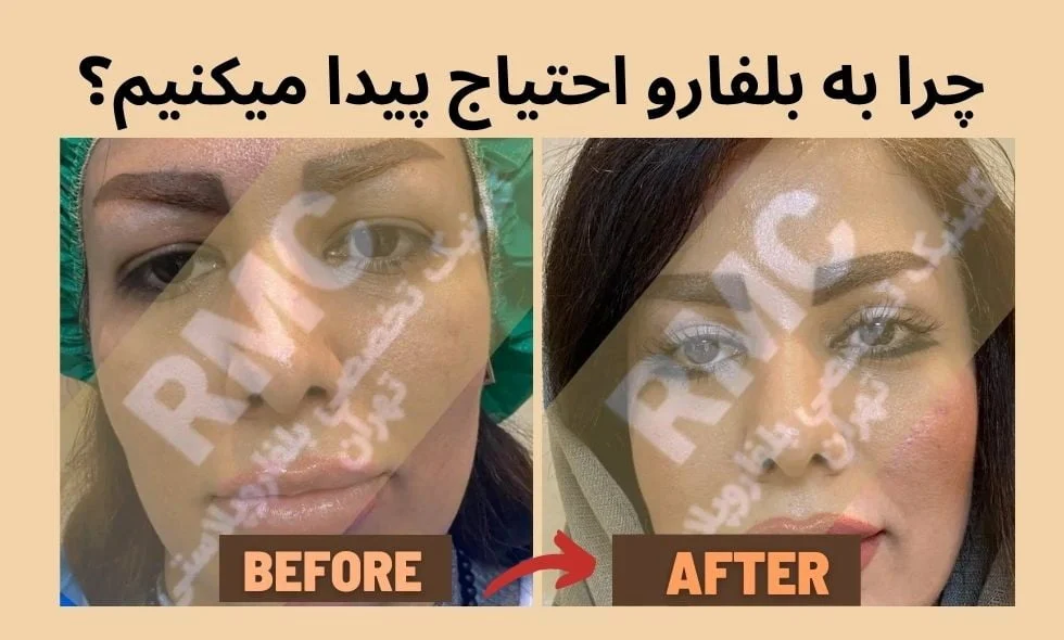 جراحی چرا به بلفارو احتیاج پیدا میکنیم؟