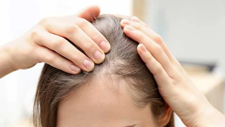 پزشکی مهمترین دلایل ریزش مو