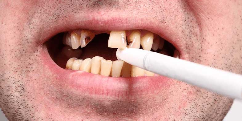ایا ایمپلنت دندان درد دارد نی نی سایت | ایمپلنت بعد از کشیدن دندان نی نی سایت
