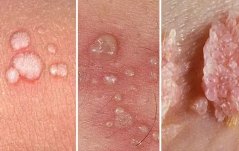 زگیل آشنایی با انواع زگیل تناسلی