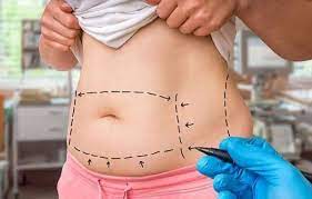 The cause of abdominal enlargement after surgery