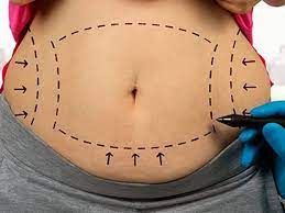 The cause of abdominal enlargement after surgery