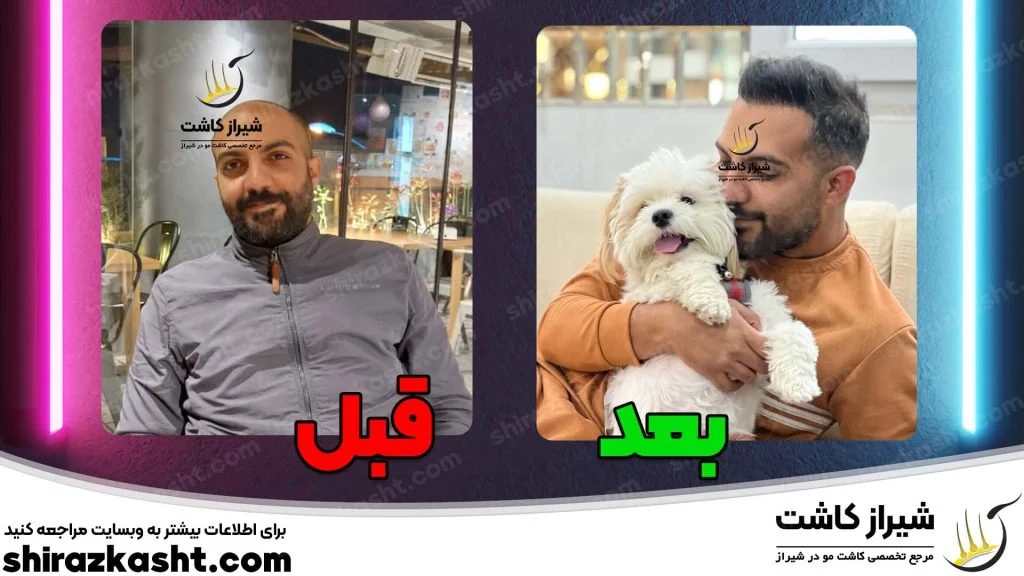 شیراز شیراز | کاشت مو