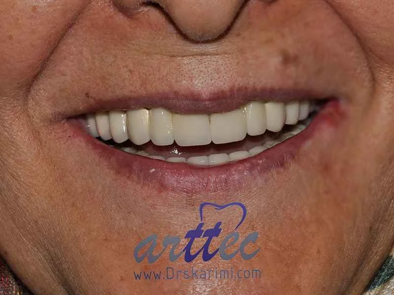 How to implant front teeth