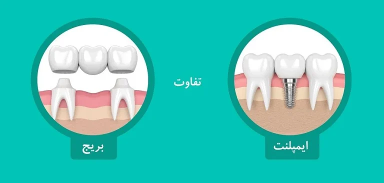 مقایسه ایمپلنت و بریج
