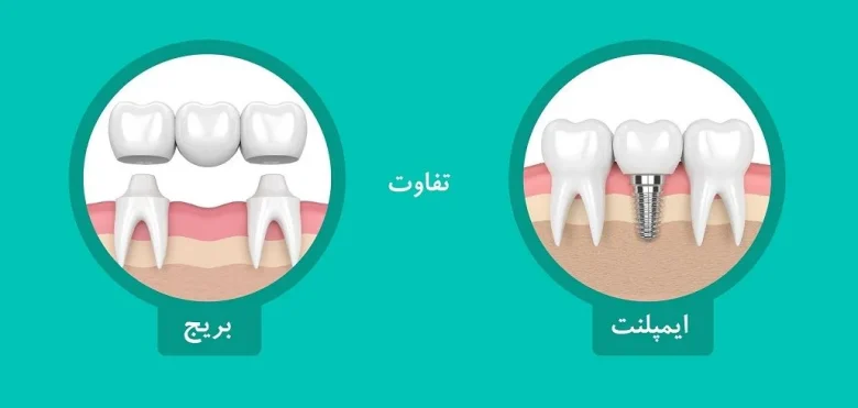 ایمپلنت