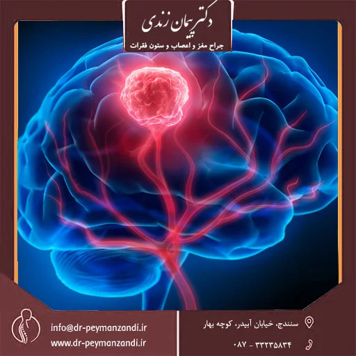 سرطان مغز