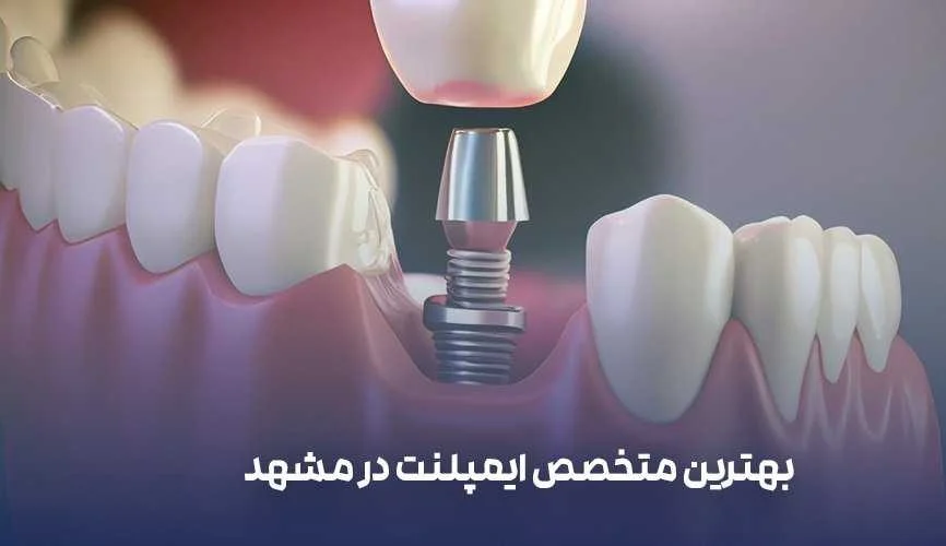 ایمپلنت | مشهد