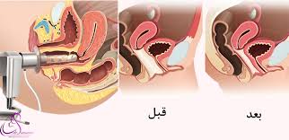 جوانسازی واژن