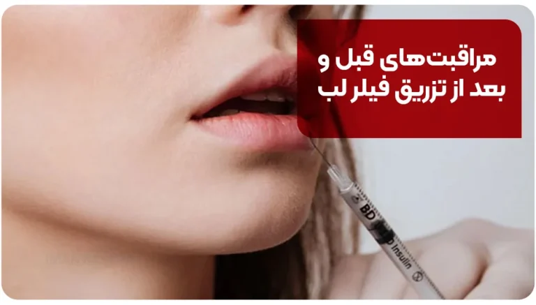 مراقبت های قبل و بعد از تزریق فیلر لب