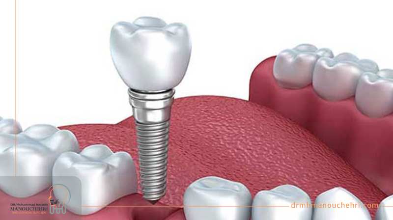 ایمپلنت ایمپلنت