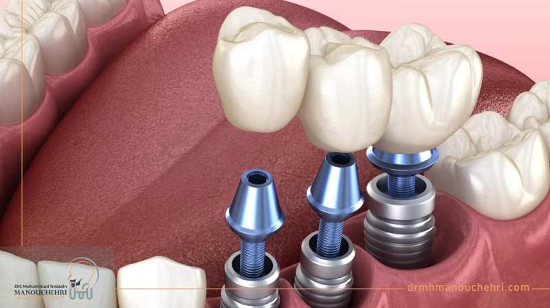 ایمپلنت بهترین دکتر ایمپلنت در اصفهان - دکتر منوچهری